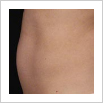 Zeltiq Fat Freezing - Coolsculpting NYC - Debra Jaliman, MD - Board Certified Dermatologist